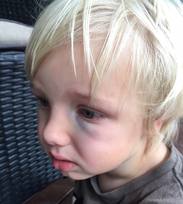 black-eye-toddler